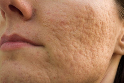 Cicatriz de acne: como prevenir e tratar