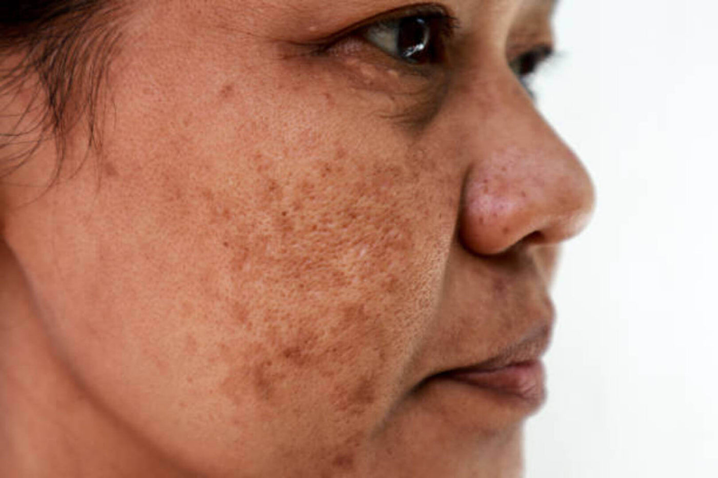 Como escolher o melhor protetor solar para melasma