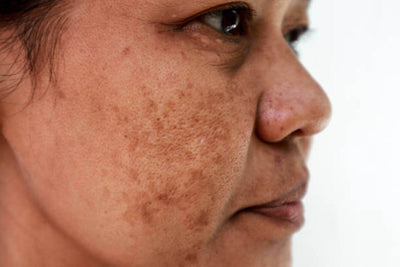 Como escolher o melhor protetor solar para melasma