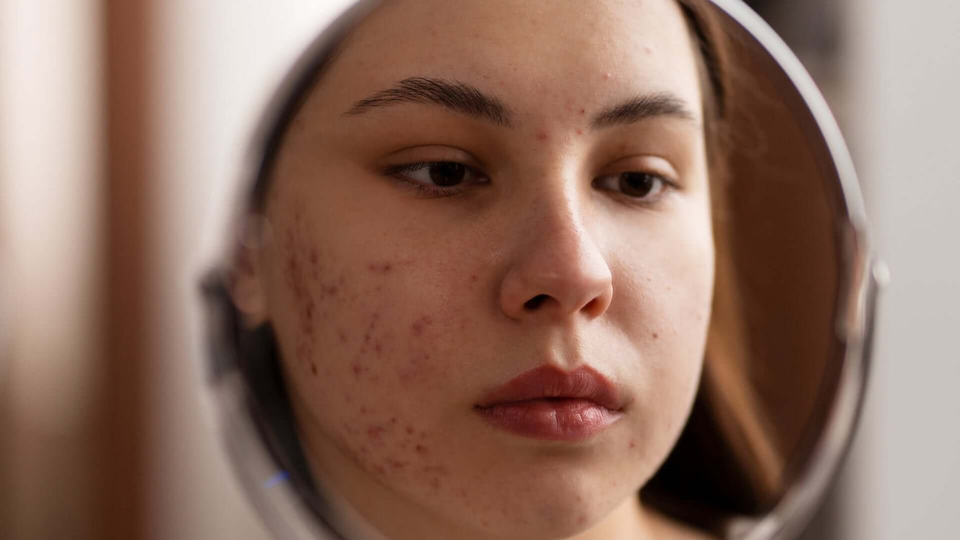 Acne solar: o que é, como prevenir e tratar