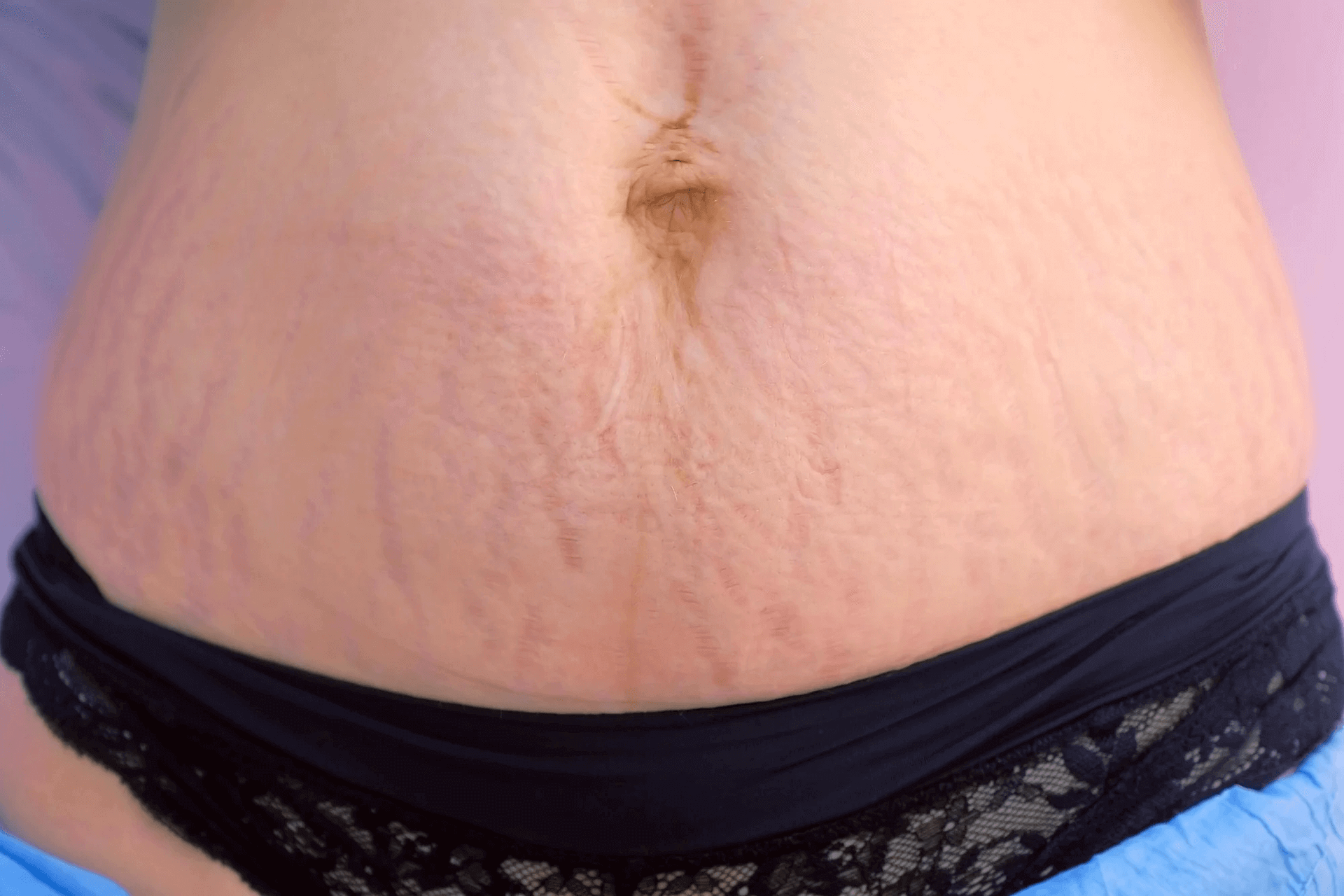 Estrias vermelhas: o que são e qual o tratamento