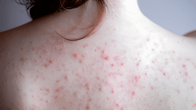 Acne fúngica: entenda o que é e como tratar