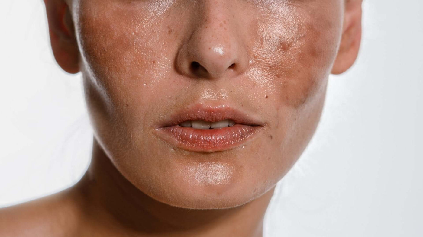 Melasma: todas as dúvidas respondidas aqui