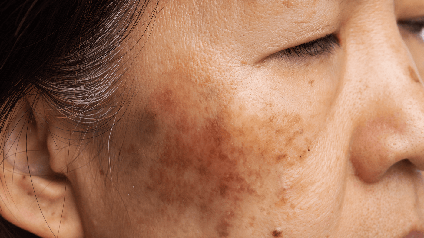 Vitamina C para melasma: quais são os benefícios do ativo