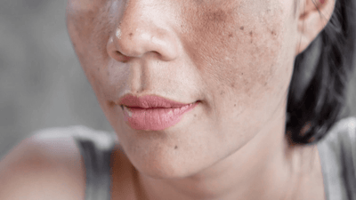 7 erros que pioram o melasma: te contamos todos aqui