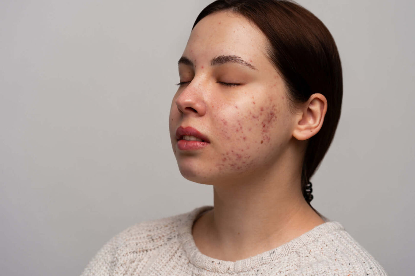 Acne adulta: e agora? Saiba tudo sobre, como surge, como tratar