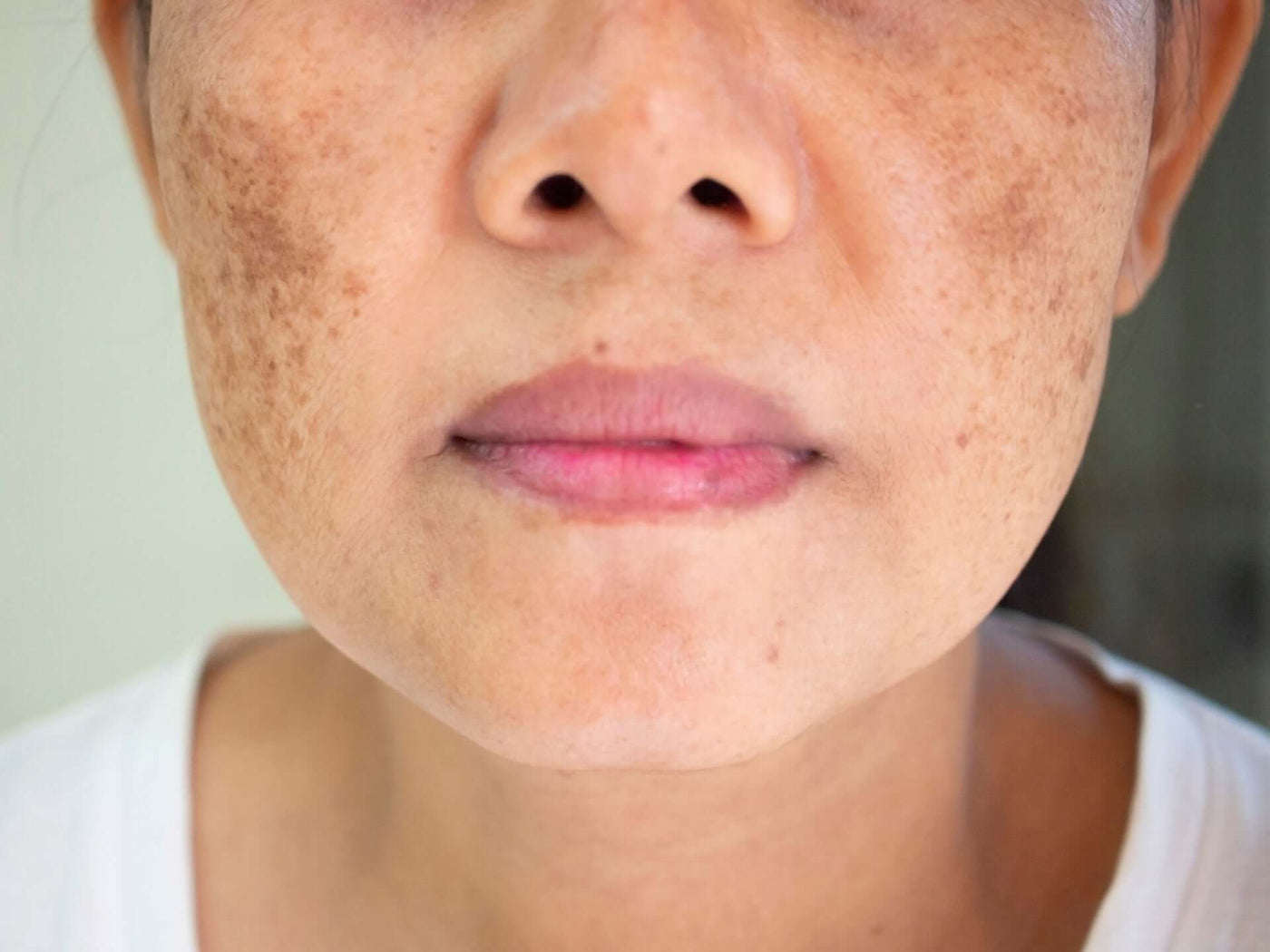 Melasma: o que é e como tratar, dermatologista tira as dúvidas