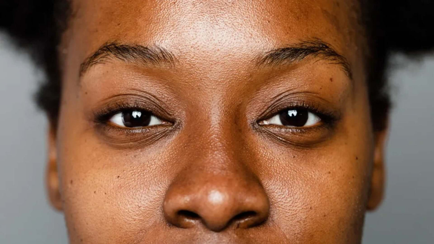 Sintomas de melasma: como identificar, tratar e cuidar