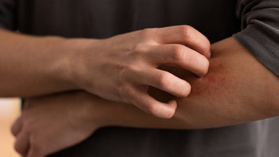 Dermatite atópica: quais são os sintomas, causas e tratamentos