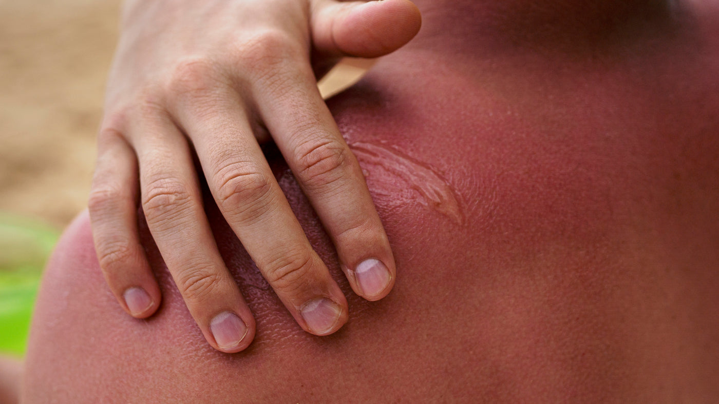 Descamação da pele: causas, tratamentos e prevenção