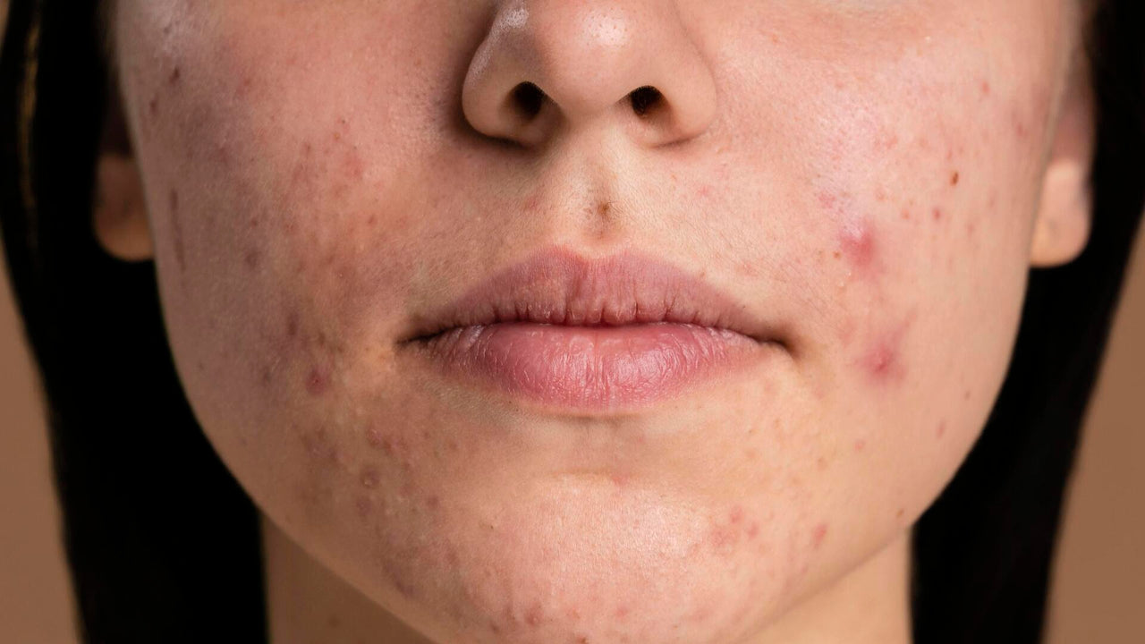 Espinha interna: saiba tudo sobre essa lesão cutânea