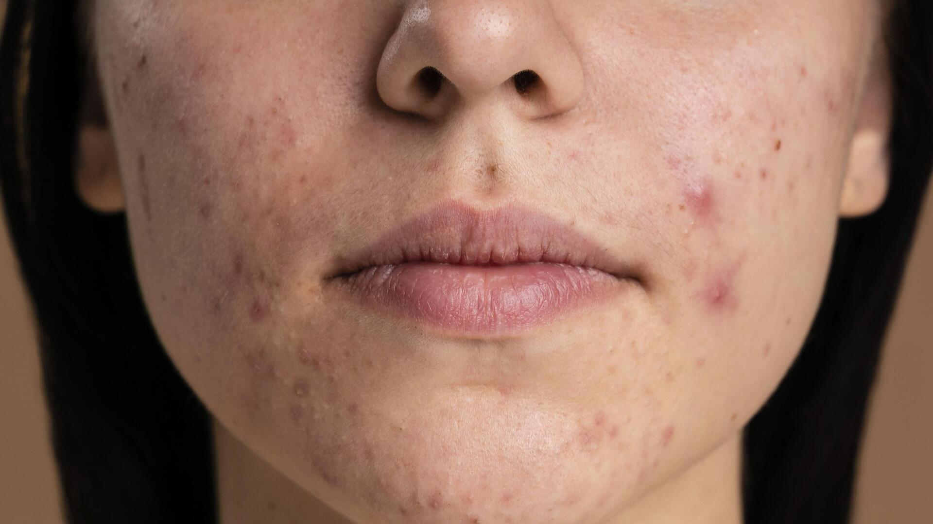 Espinha interna: saiba tudo sobre essa lesão cutânea