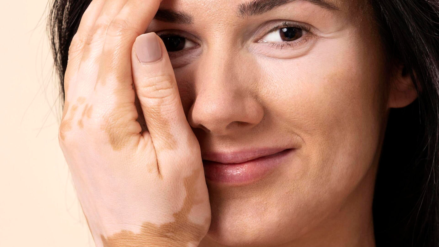 Manchas brancas na pele: como surgem e quais os tratamentos