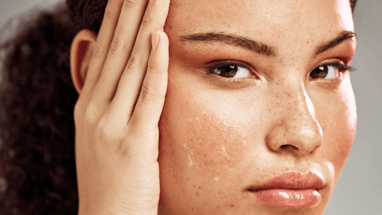 Xerose cutânea: o que é, e quais os tratamentos indicados