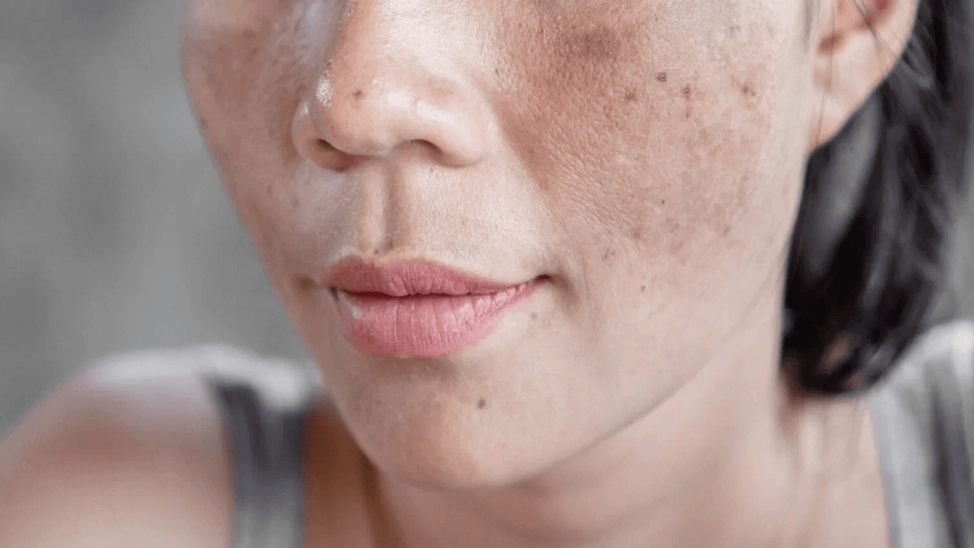 7 erros que pioram o melasma: te contamos todos aqui