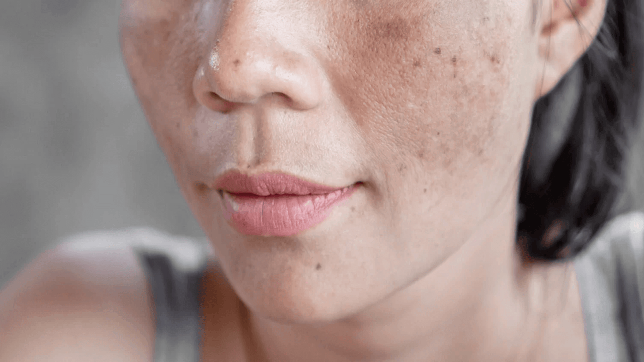 7 erros que pioram o melasma: te contamos todos aqui