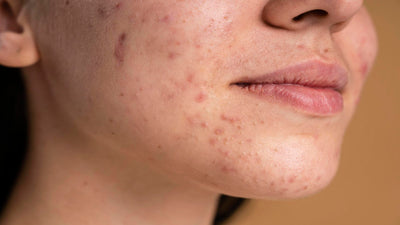 Acne e espinha: o que é, como cuidar e tratar. Descubra!