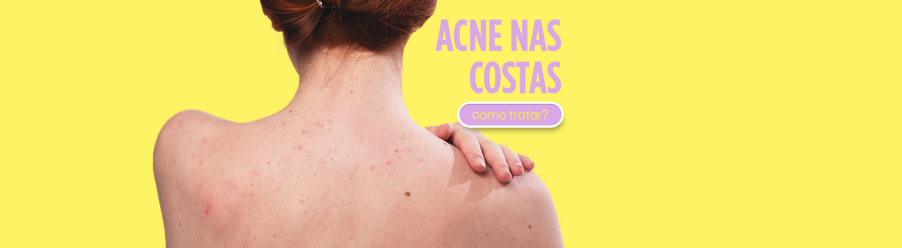 Acne nas Costas: Como Tratar e Manter a Pele Limpa