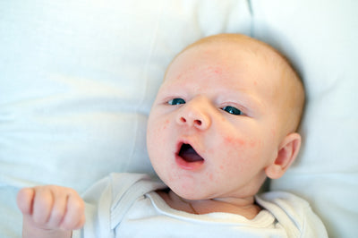 Acne neonatal: saiba o que é e como tratar as espinhas no bebê