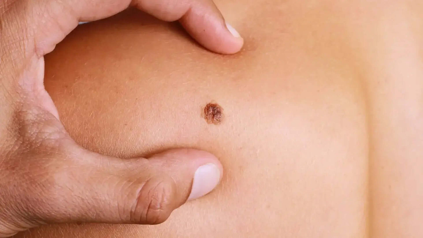 Melanoma: o que é, sintomas, causas, tratamentos e prevenção