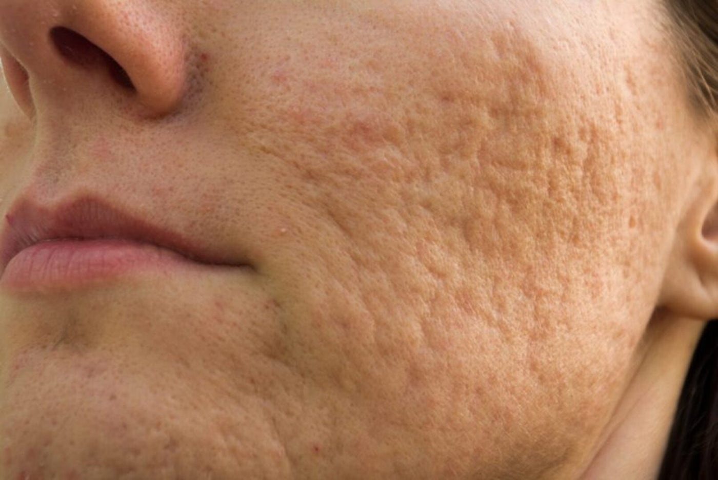 Cicatriz de acne: como prevenir e tratar