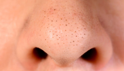 Cravos no nariz: como cuidar sem agredir sua pele