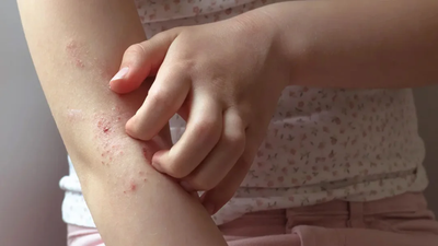 Dermatite infantil: quais os sintomas e como tratar