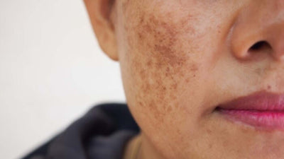 Melasma: qual a relação com a limpeza do fígado?