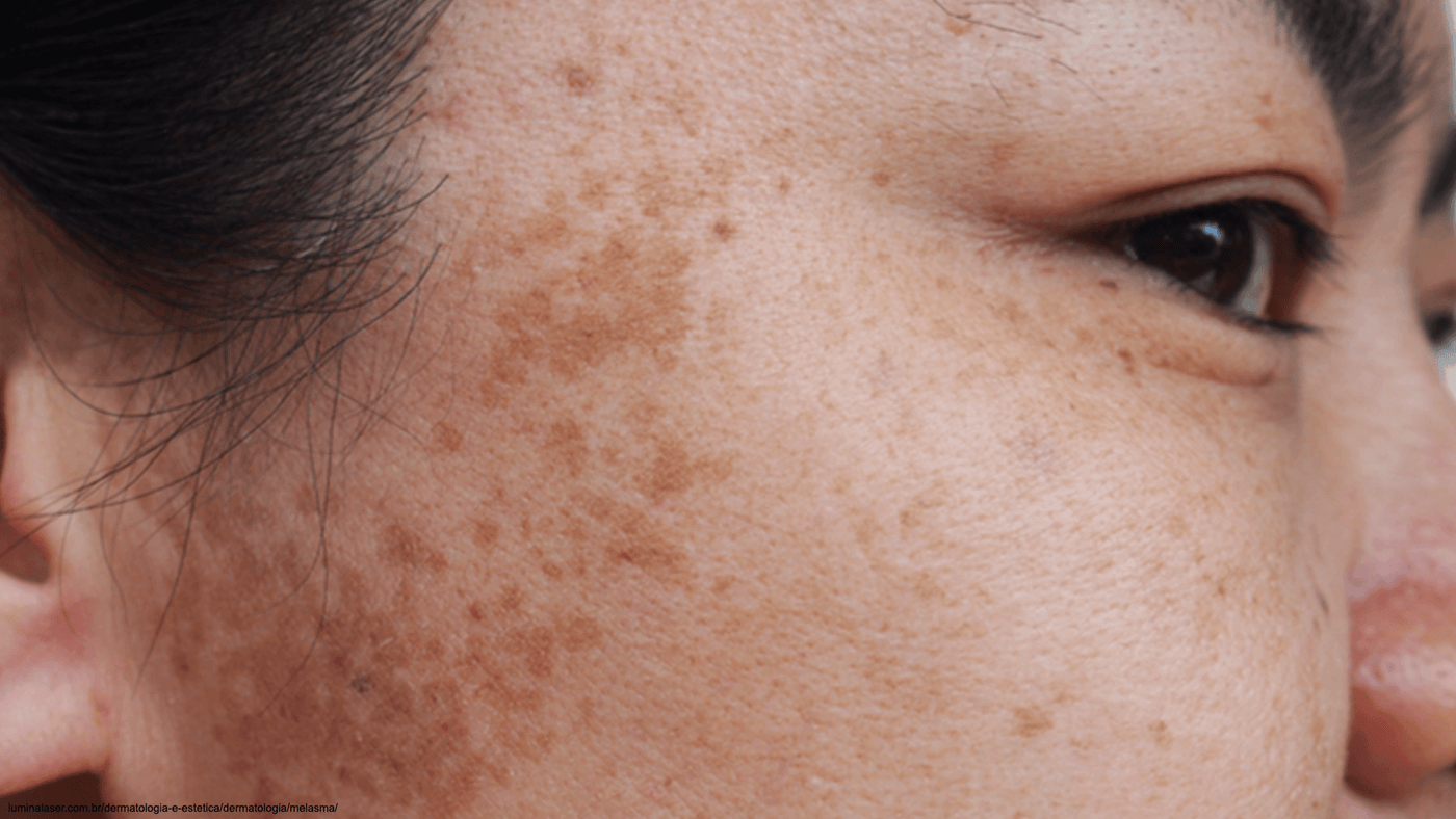 Melasma: como o protetor solar pode evitar e tratar