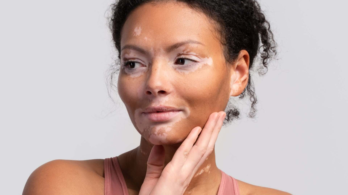 Autocuidados para vitiligo: conheça as melhores práticas