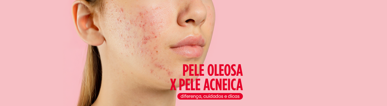 Pele Oleosa x Pele Acneica: Diferença, Cuidados & Dicas.